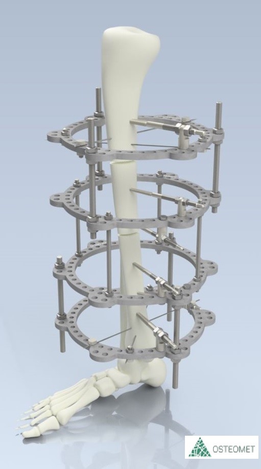 ТМ OSTEOMET Апарат Ілізарова в комплектації ГОМІЛКА